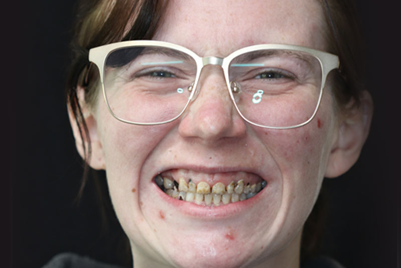 Smile before dental implant treatment