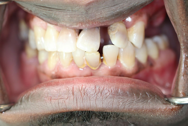 Smile before dental implant treatment