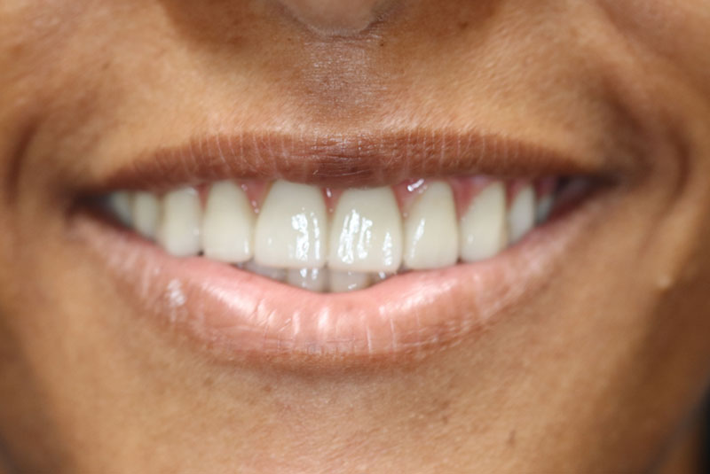 Smile after dental implant treatment
