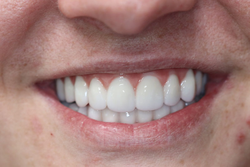 Smile after dental implant treatment
