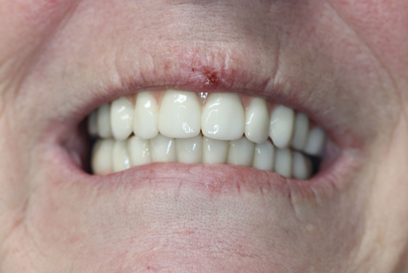 Smile after dental implant treatment