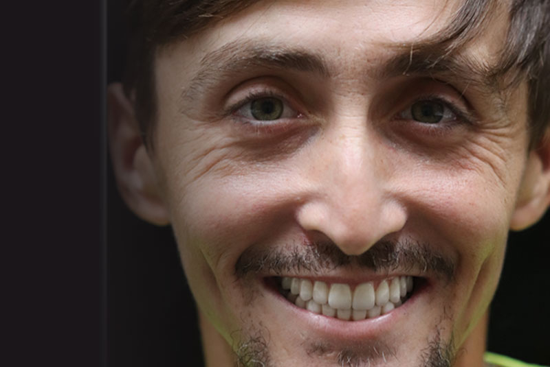 Smile after dental implant treatment