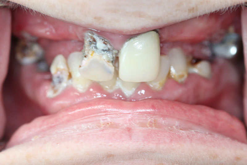 Smile before dental implant treatment