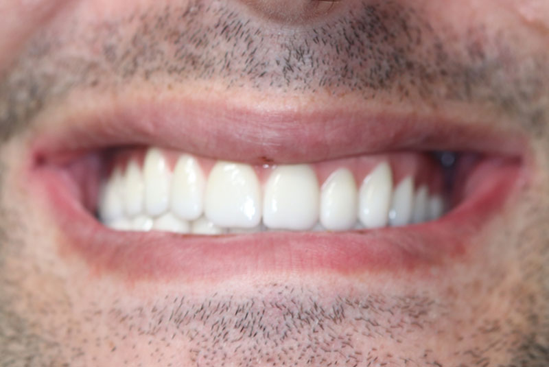 Smile after dental implant treatment