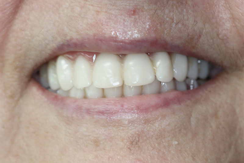 Smile after dental implant treatment