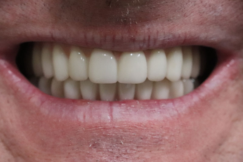 Smile after dental implant treatment