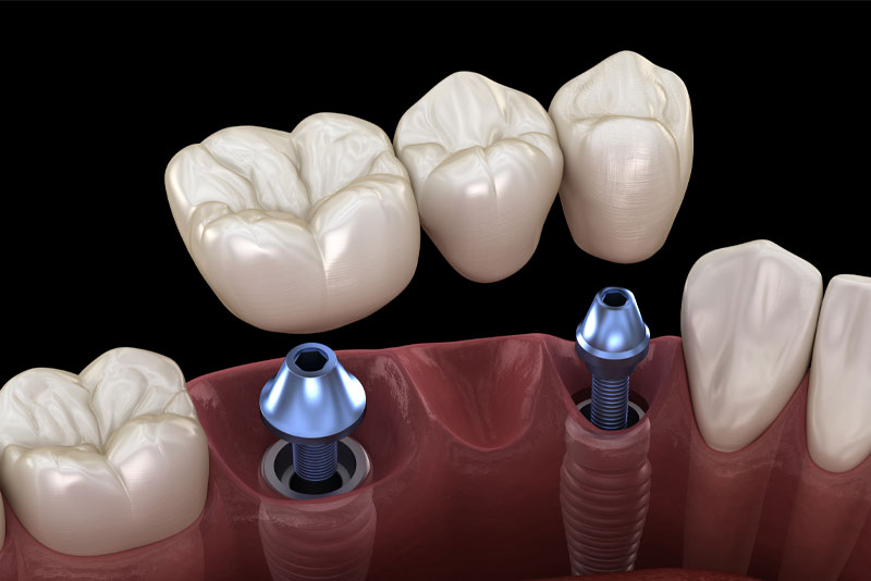 Implant-Supported Bridge