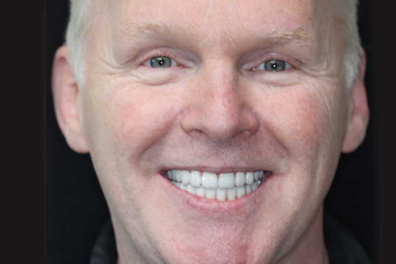 Smile after dental implant treatment