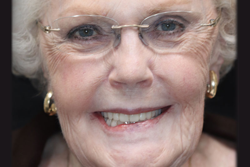 Smile after dental implant treatment