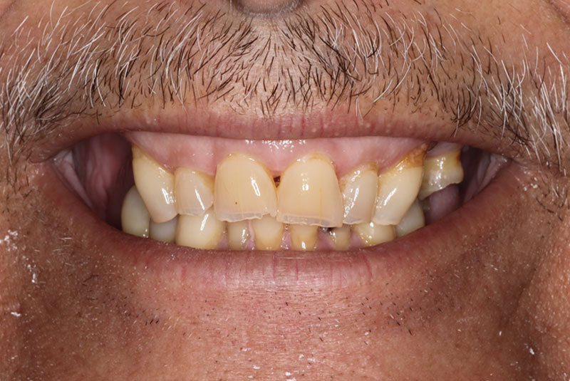 Smile before dental implant treatment