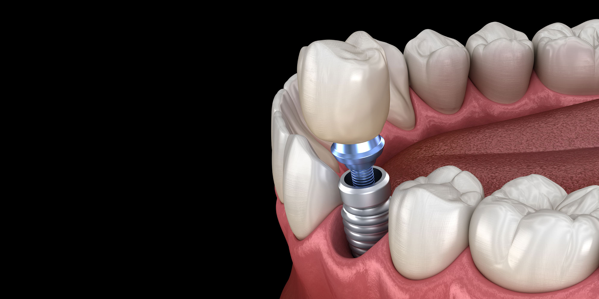 Dental Implants