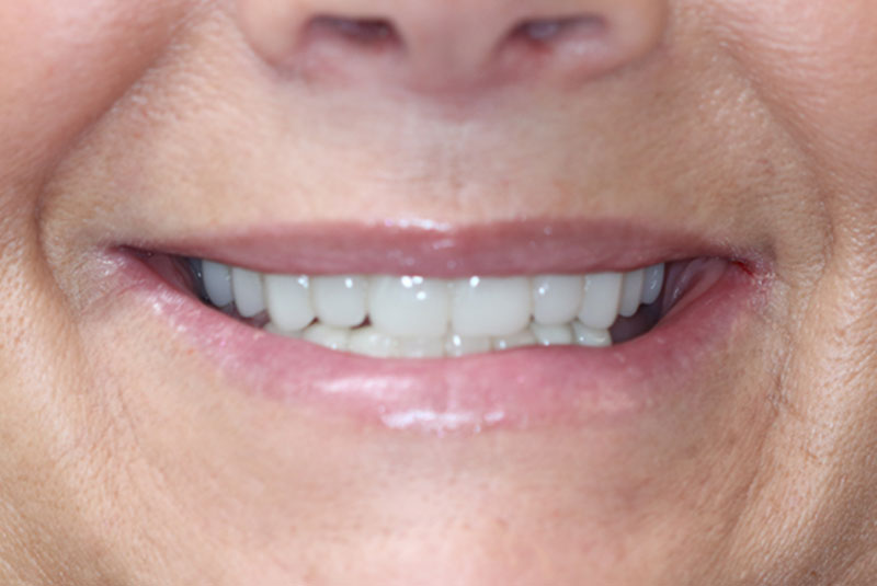 Smile after dental implant treatment