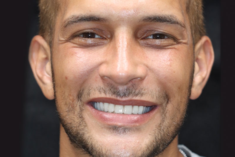 Smile after dental implant treatment