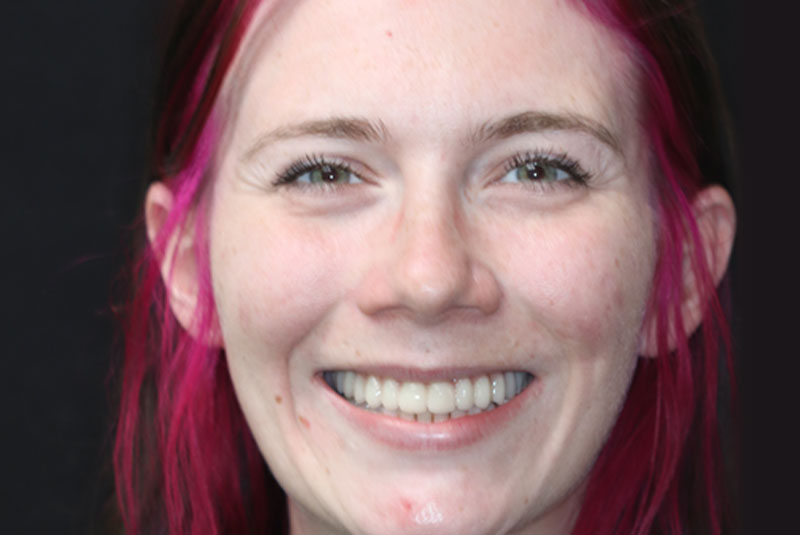 Smile after dental implant treatment