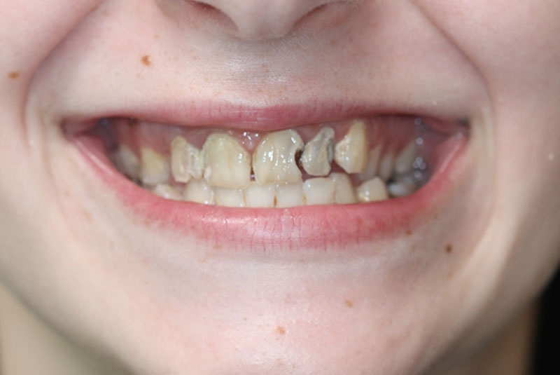 Smile before dental implant treatment