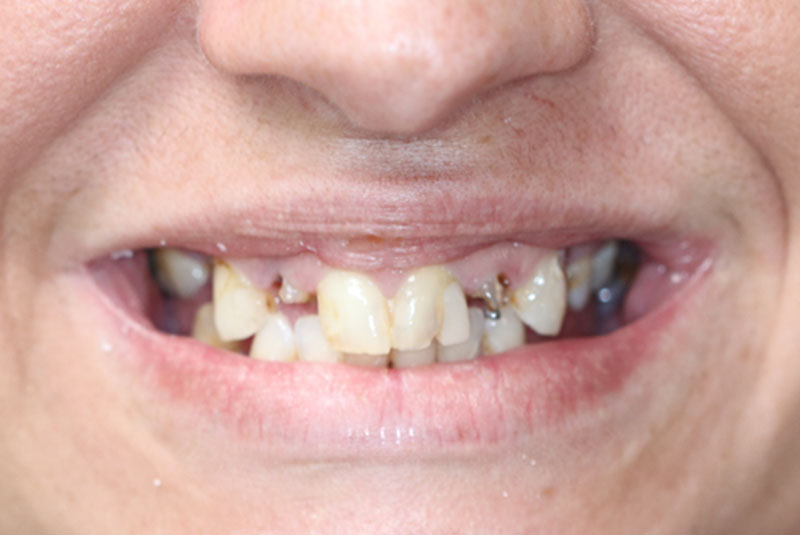 Smile before dental implant treatment