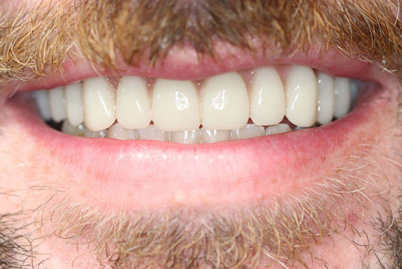 Smile after dental implant treatment