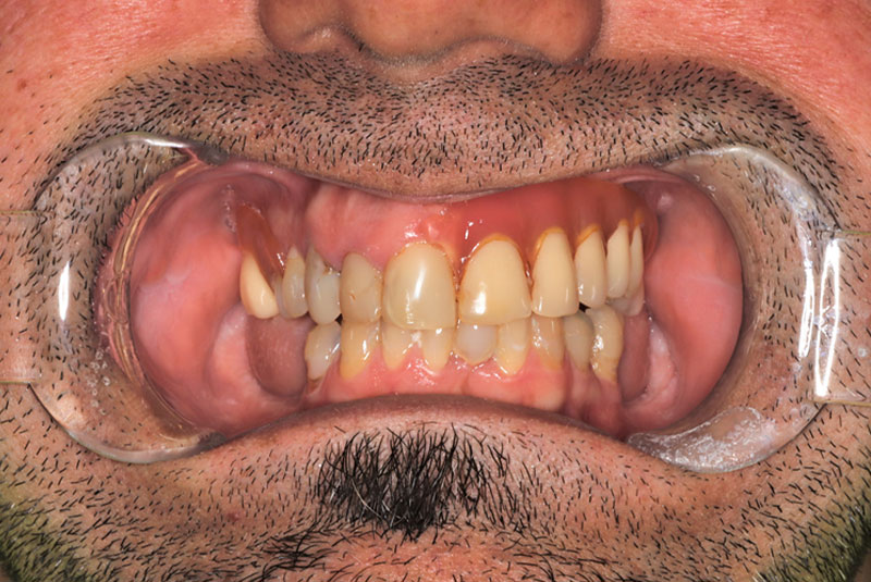 Smile before dental implant treatment