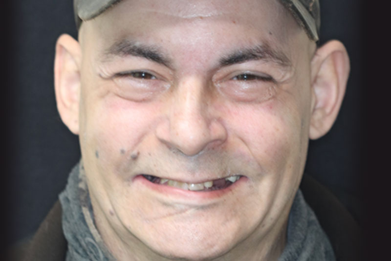Smile before dental implant treatment