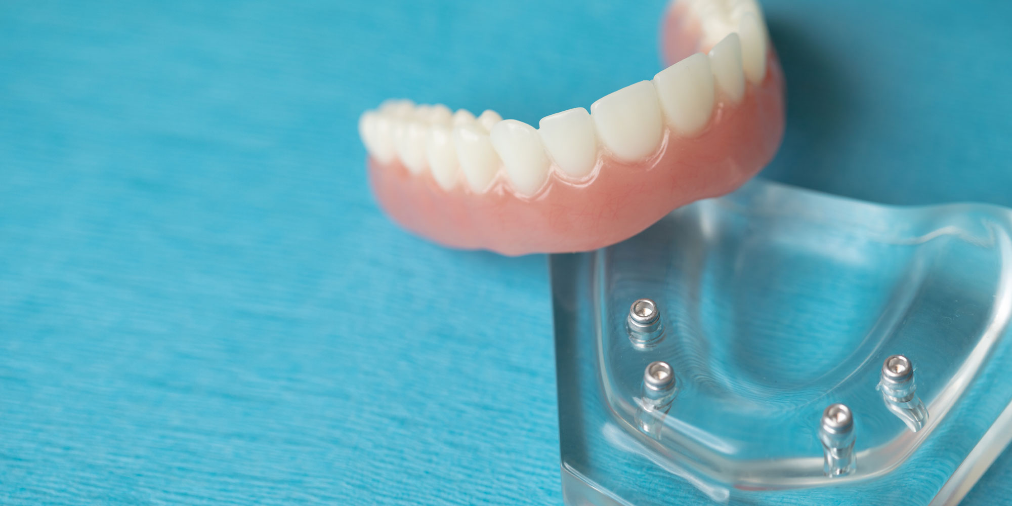 Full arch implant prosthesis anchored on four implants