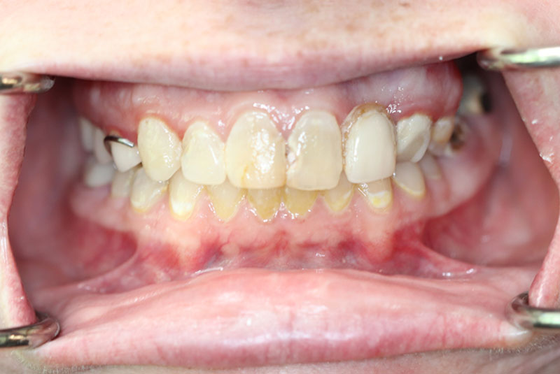 Smile before dental implant treatment