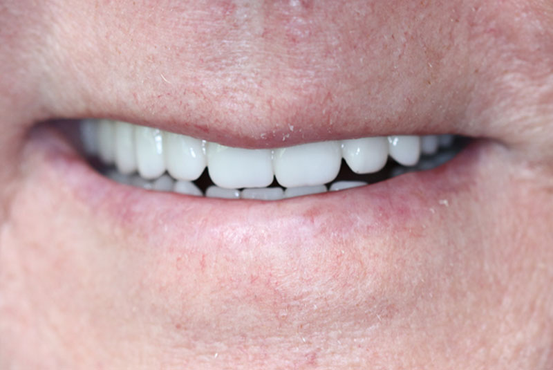 Smile after dental implant treatment