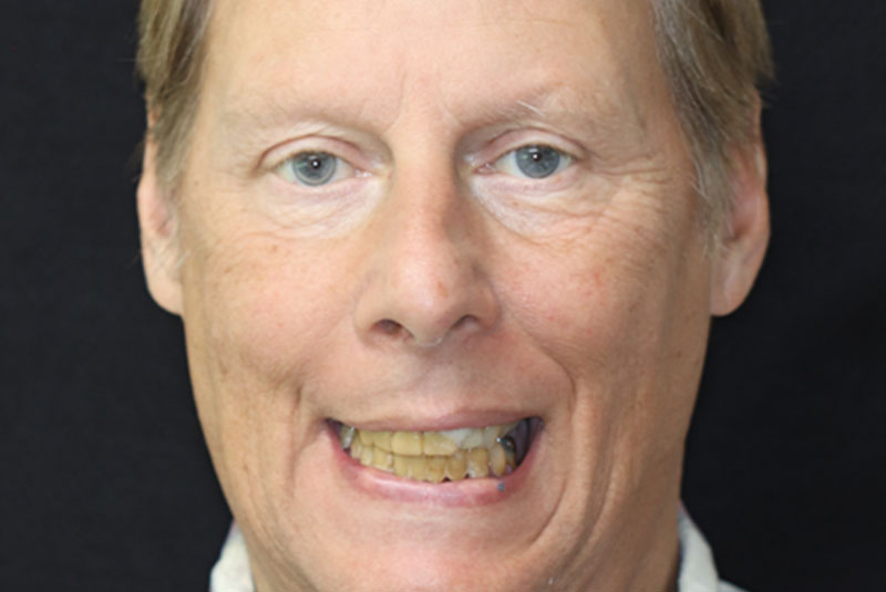 Smile before dental implant treatment