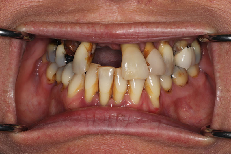 Smile before dental implant treatment