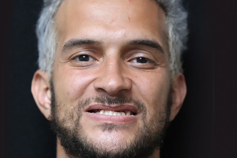 Smile before dental implant treatment