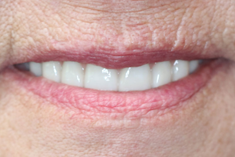 Smile after dental implant treatment