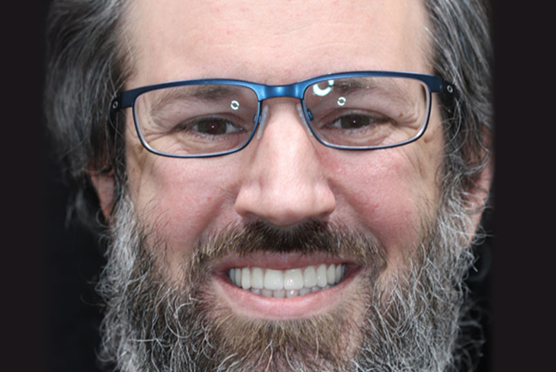 Smile after dental implant treatment