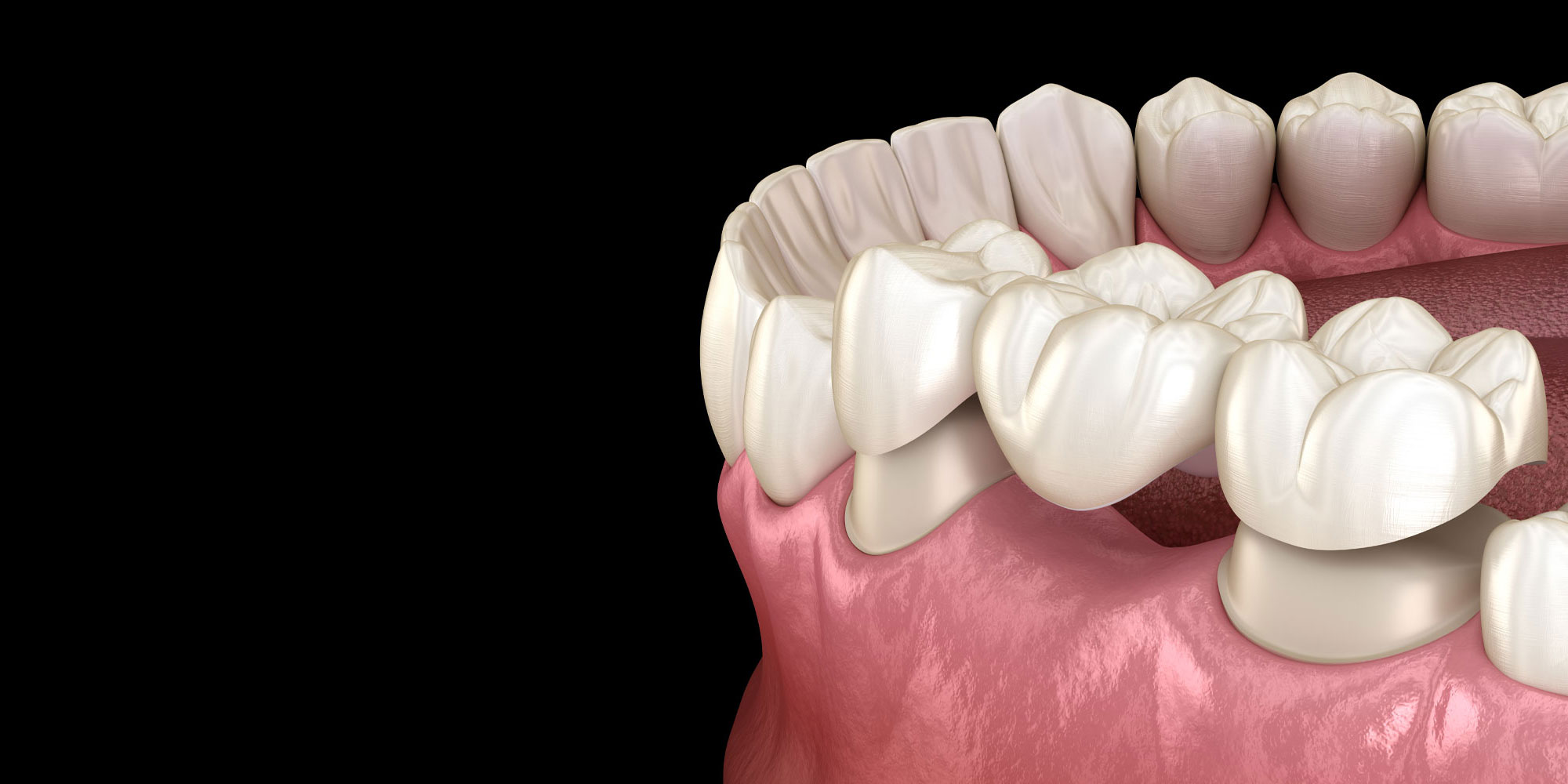 Dental Bridges