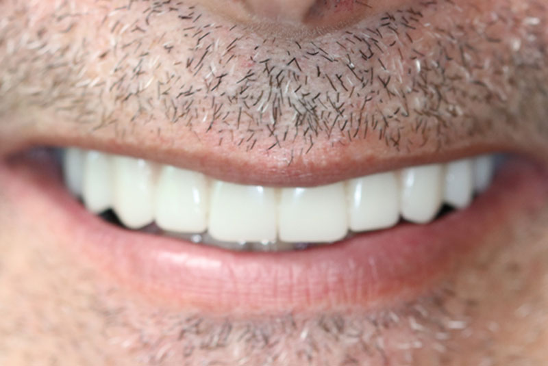 Smile after dental implant treatment