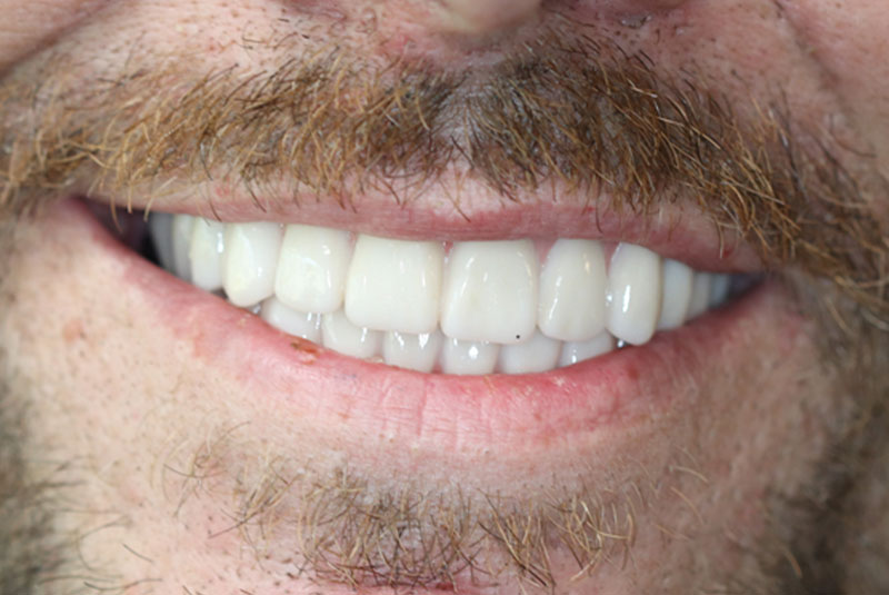 Smile after dental implant treatment