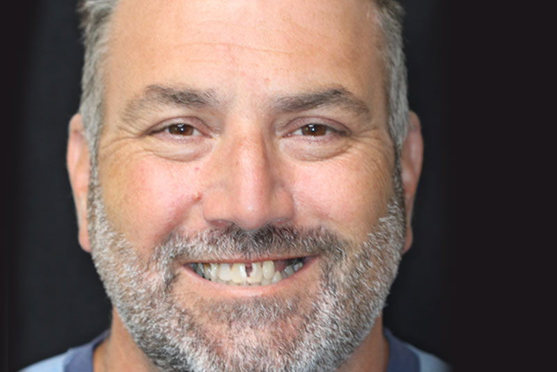 Smile before dental implant treatment