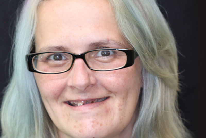 Smile before dental implant treatment