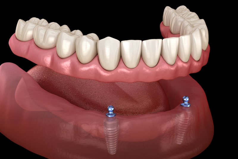 Implant-Supported Dentures