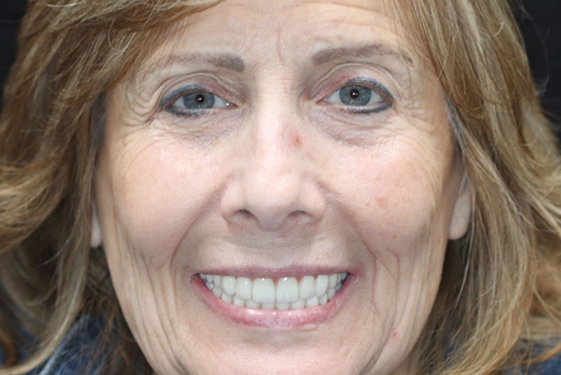 Smile after dental implant treatment