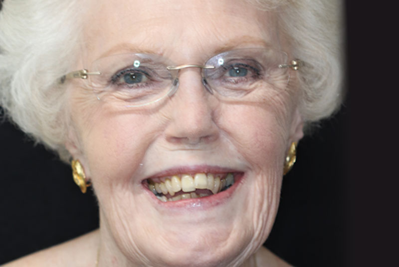 Smile before dental implant treatment