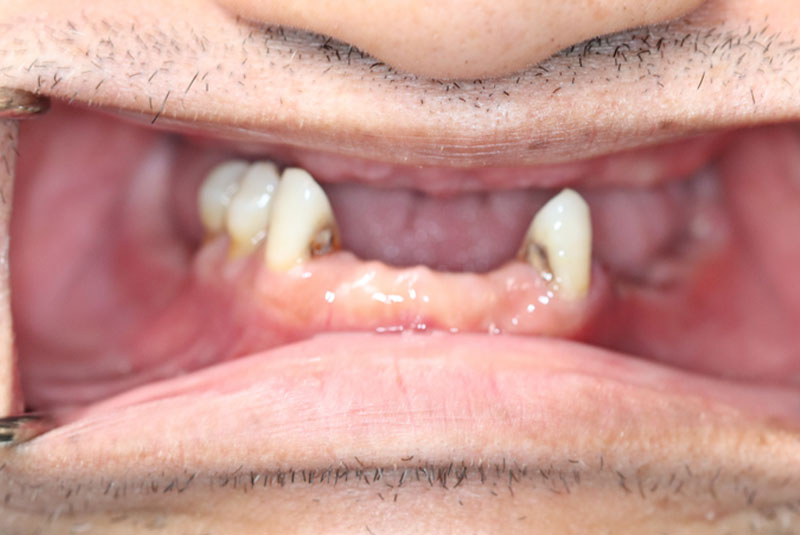 Smile before dental implant treatment