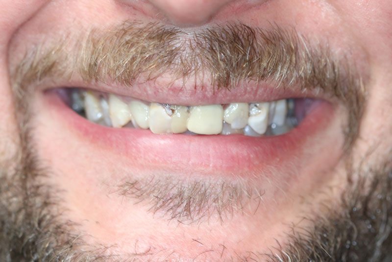 Smile before dental implant treatment