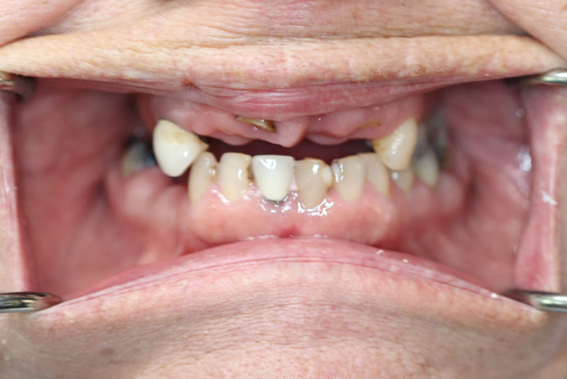 Smile before dental implant treatment
