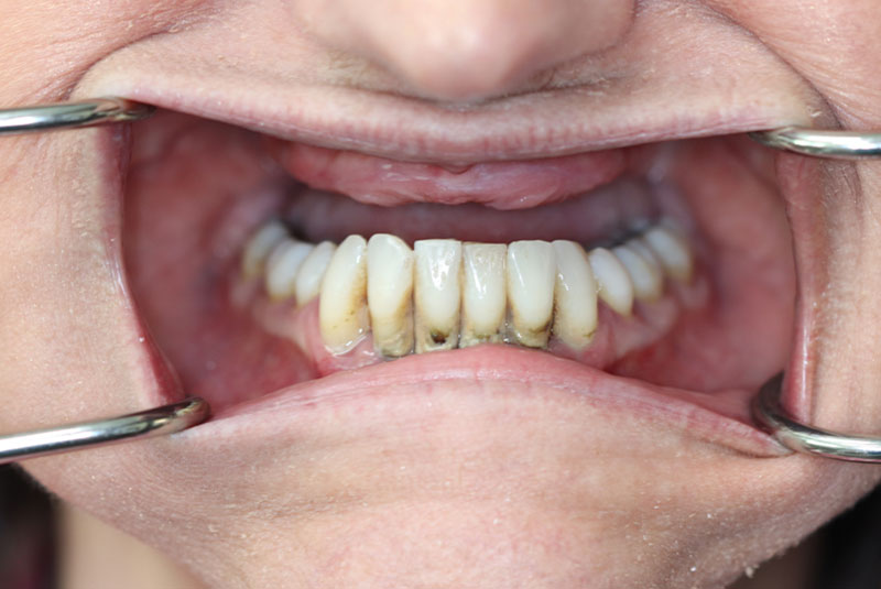 Smile before dental implant treatment
