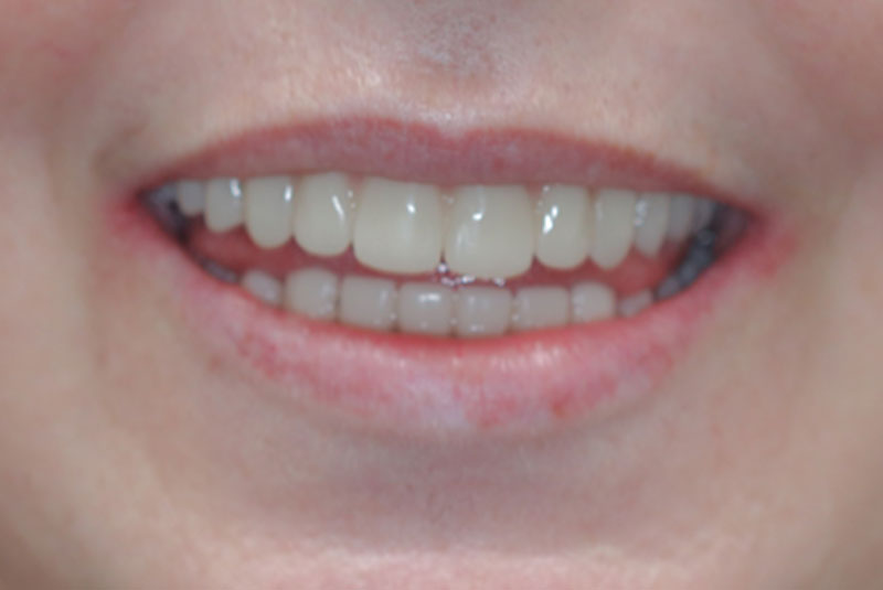 Smile after dental implant treatment