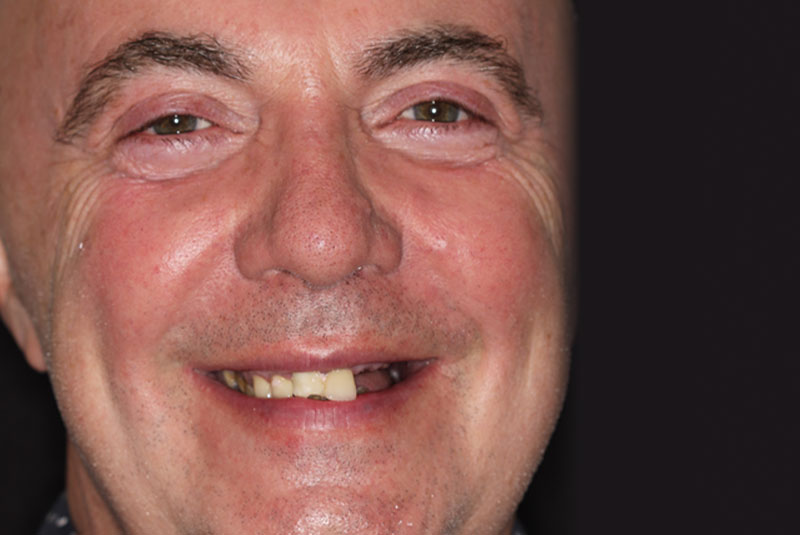 Smile before dental implant treatment