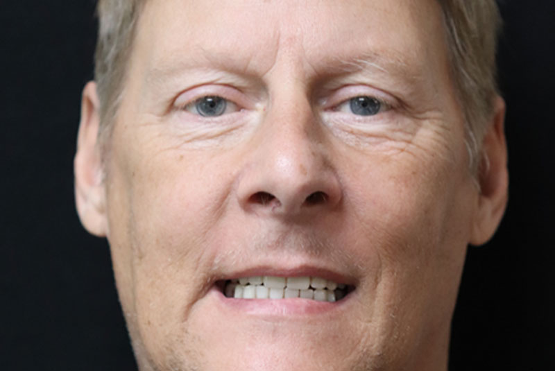 Smile after dental implant treatment