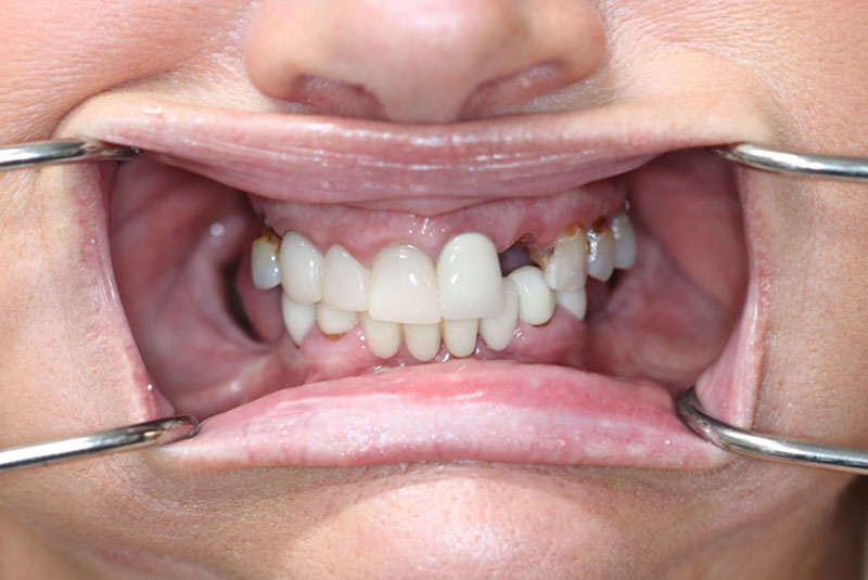 Smile before dental implant treatment
