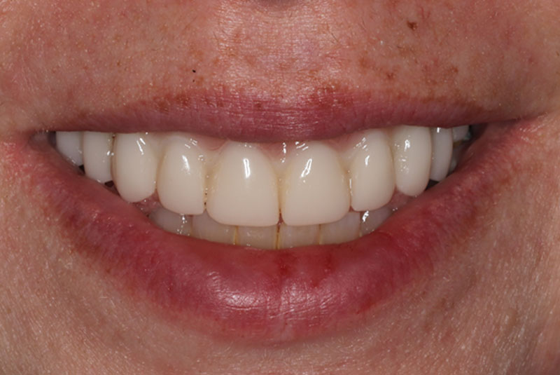 Smile after dental implant treatment