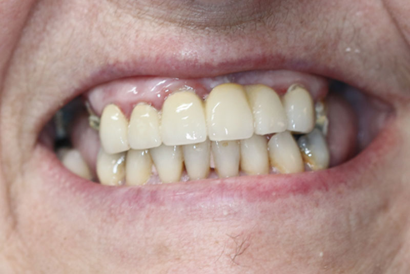Smile before dental implant treatment
