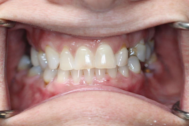 Smile before dental implant treatment